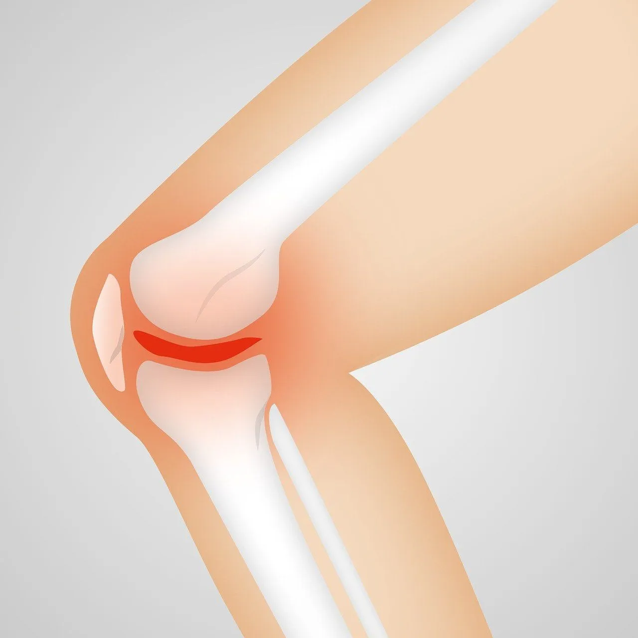 arthrose knie naturwohl gesundheit via pixabay