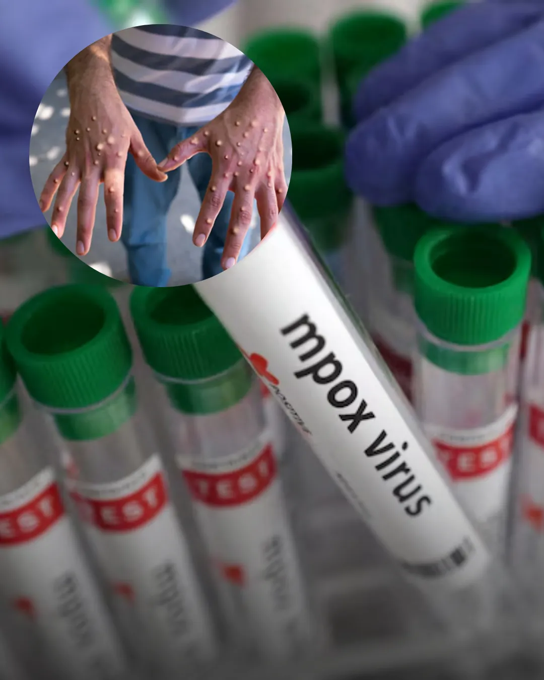 Nieuwe mpox-variant voor het eerst vastgesteld in Frankrijk