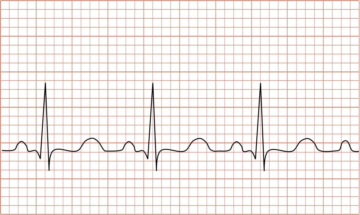 ecg hartfilmpje