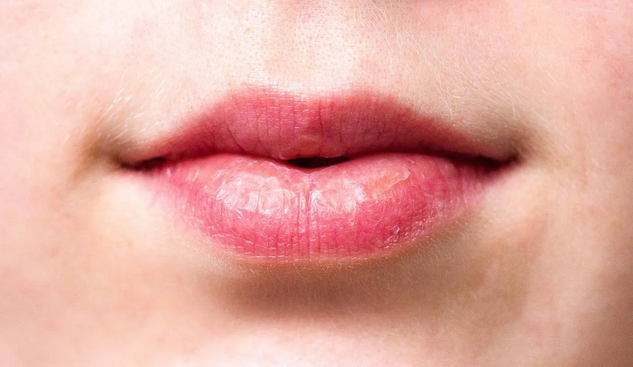 Veel mensen hebben nu last van dit winters ongemak: Tips om gebarste lippen te verzorgen