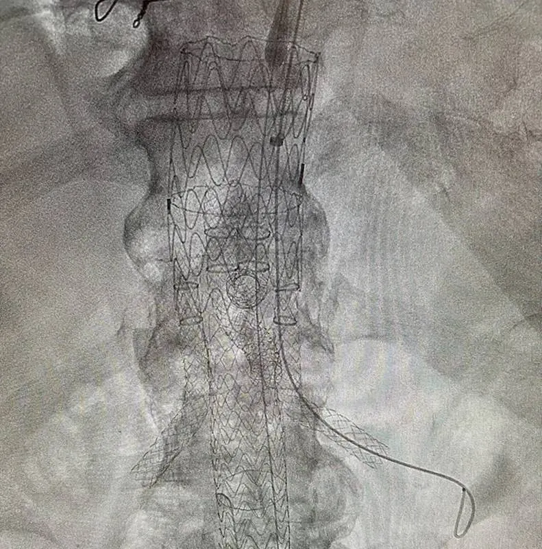 stent-vaatchirurgie-WEB