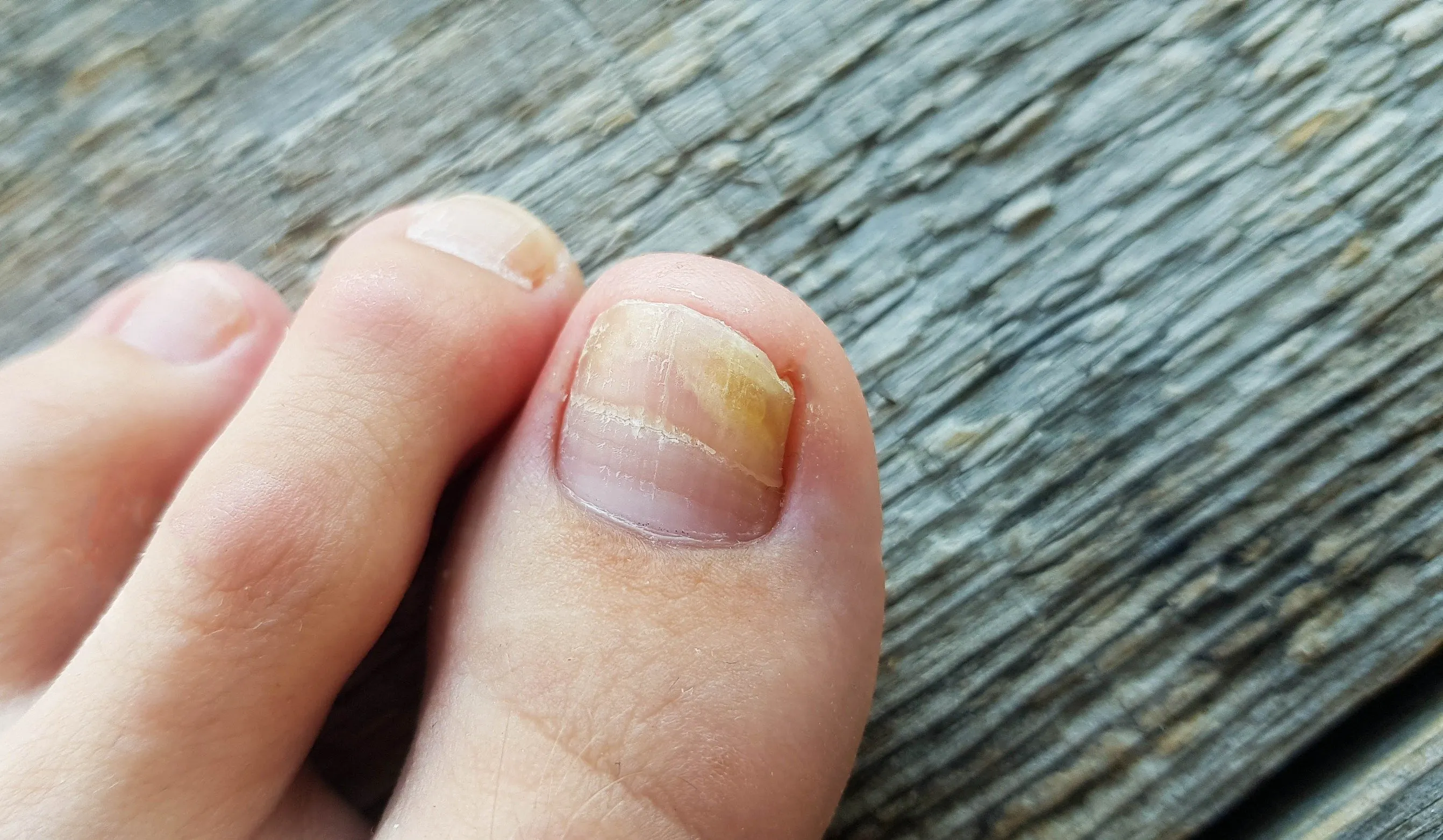 Toename van schimmelnagelinfecties in zwembaden en ruimtes waar mensen blootsvoets lopen
