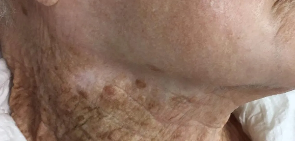Deze vrouw gebruikte altijd zonnebrandcrème - maar alleen op haar gezicht