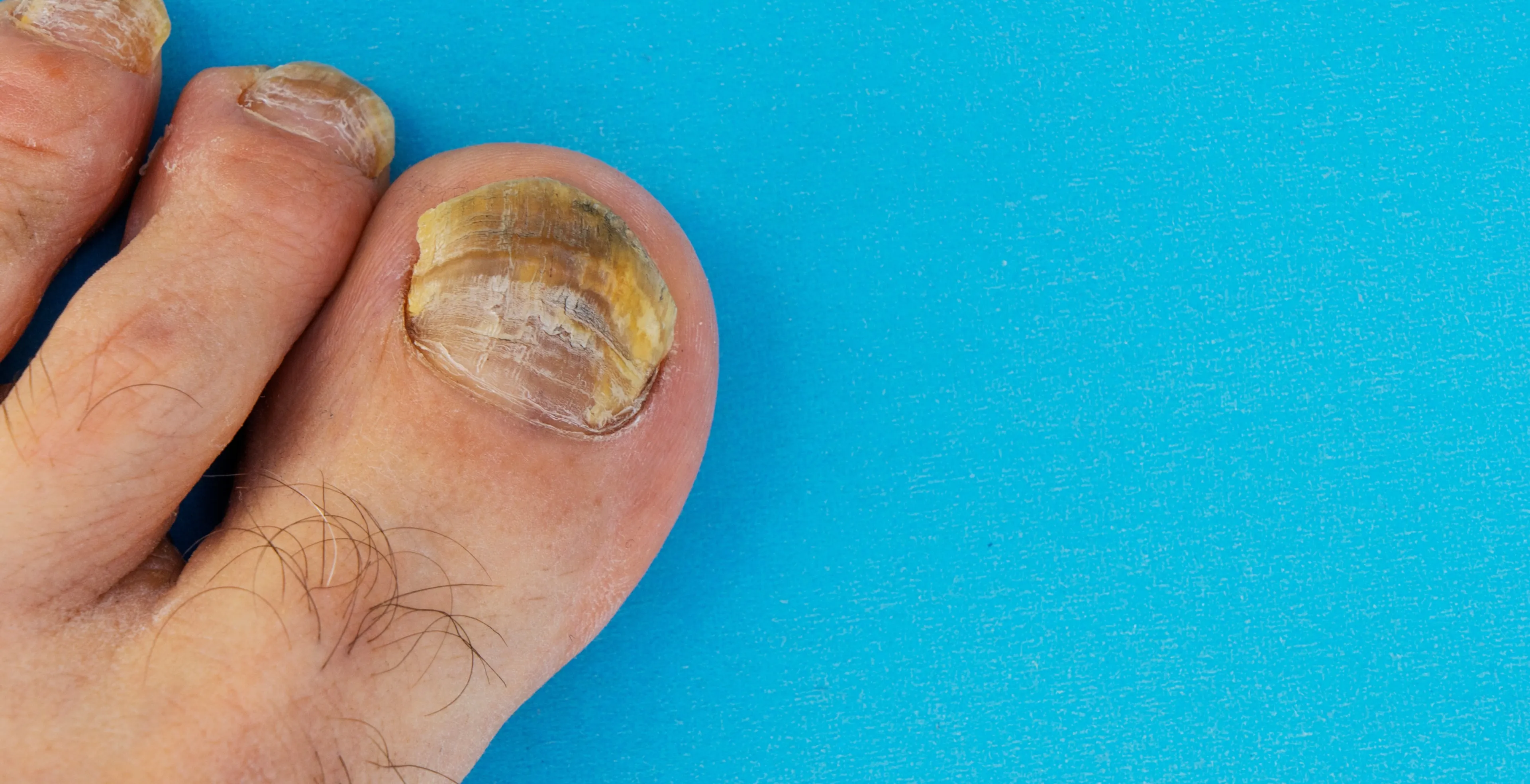 Van kanker tot hartproblemen: wat zeggen je nagels over je gezondheid?