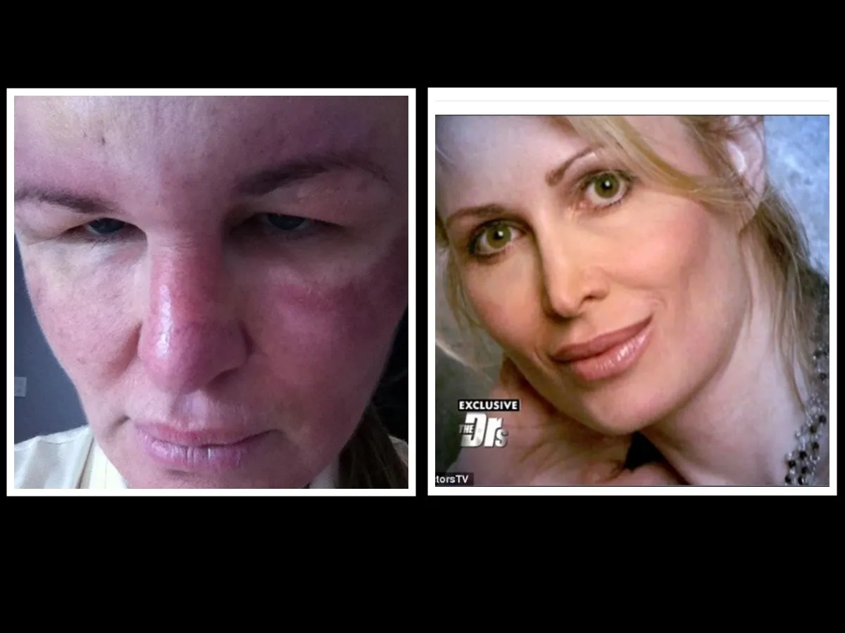 Deze mooie vrouw vond toch dat ze plastische chirurgie nodig had. Het resultaat is verschrikkelijk