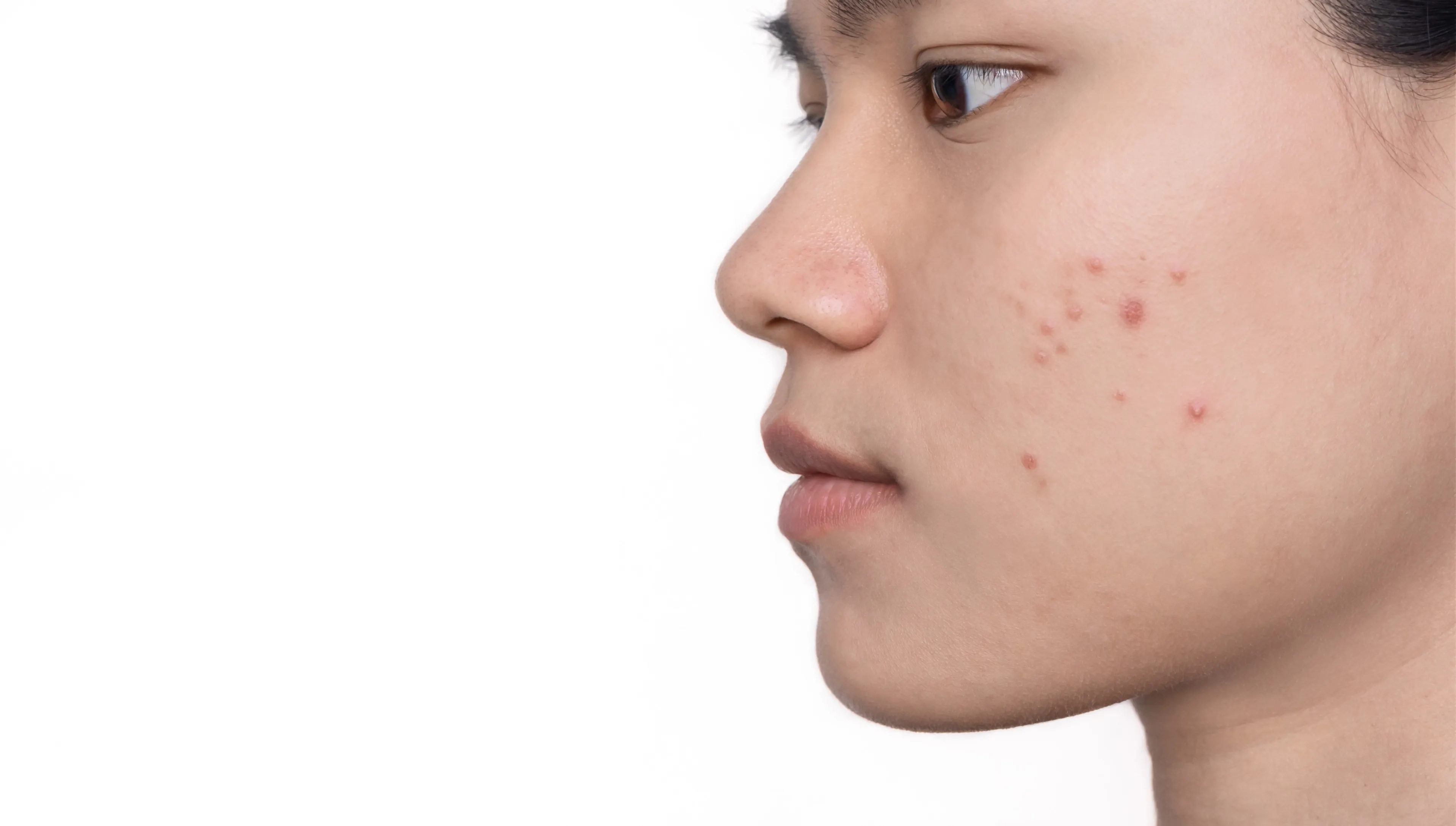 Onderzoekers ontdekken groot voordeel van acne