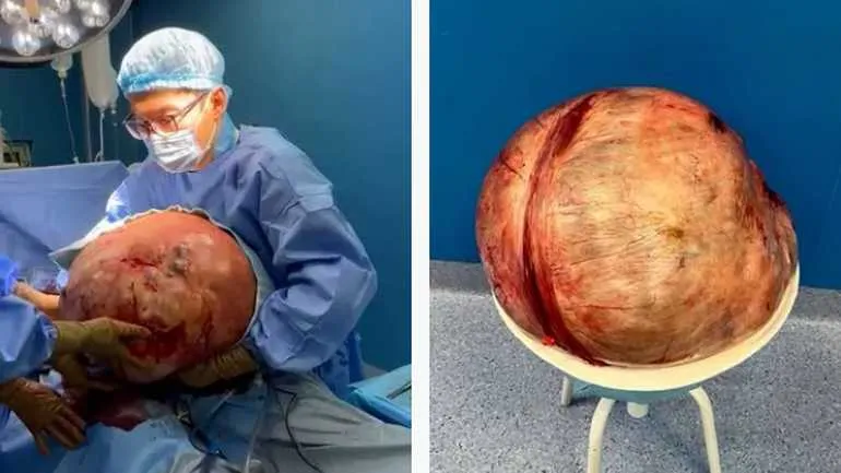 tumor