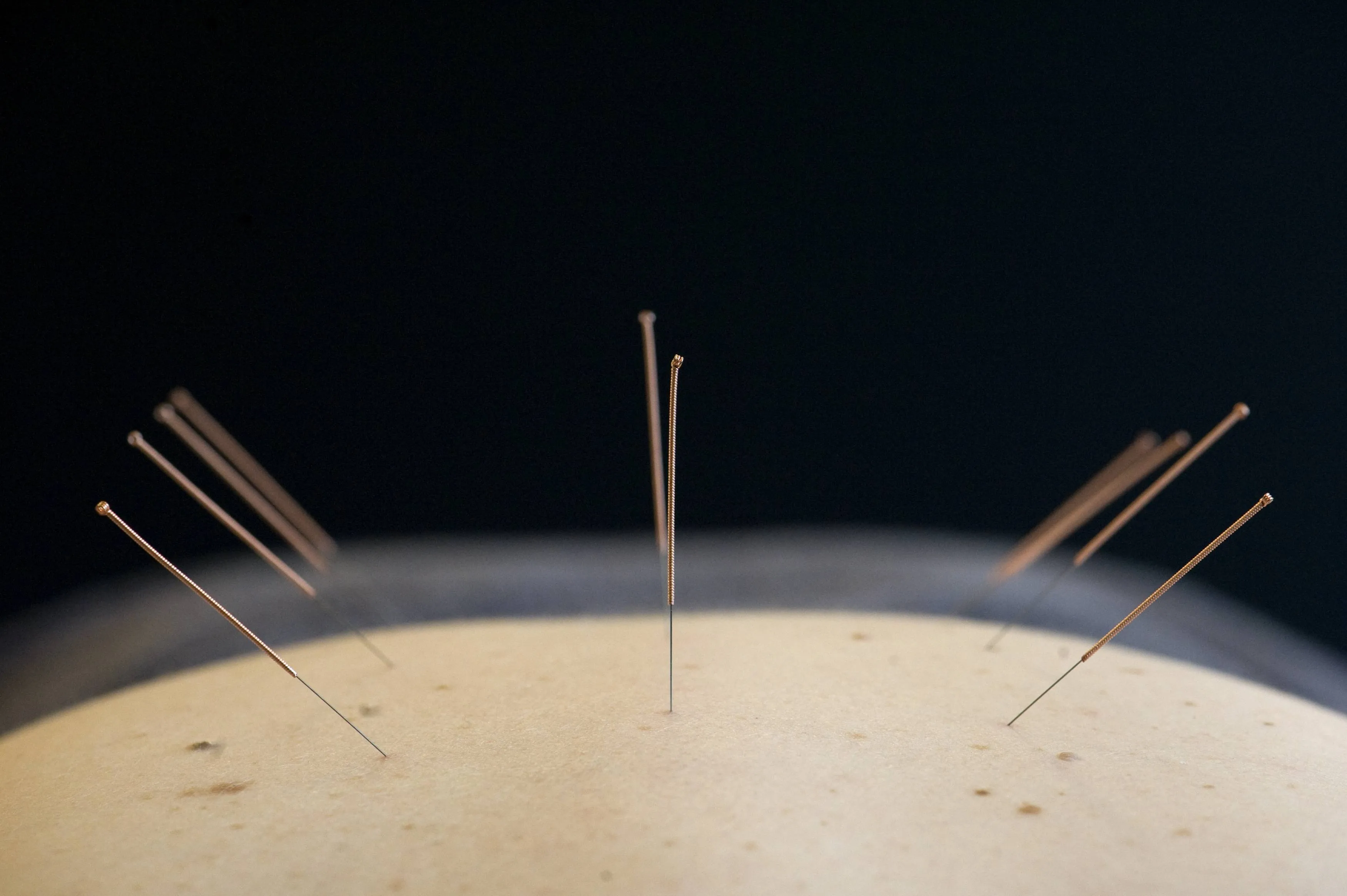 Acupunctuur is opnieuw populair, maar werkt het ook volgens de wetenschap?