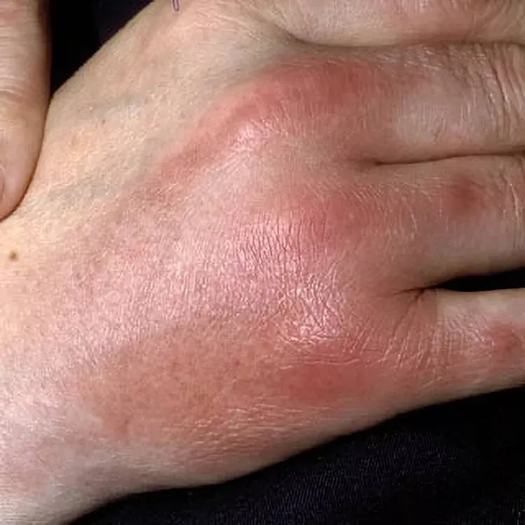 VWH-DermNetNZ-Panniculitis-01-76febbb615f4442988c74db6a46187ba