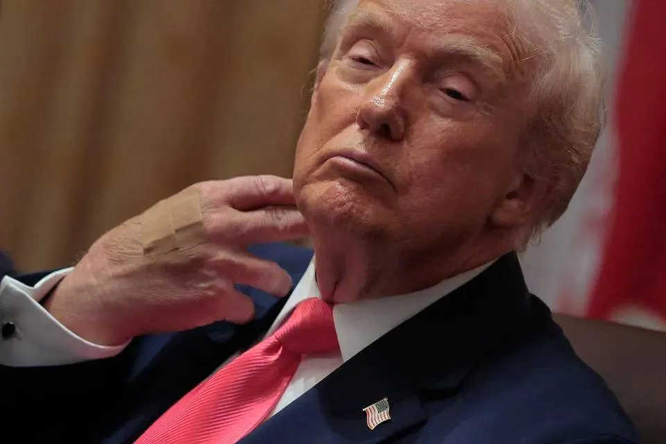 Waarom was de hand van Trump blauw en zit die nu in verband?