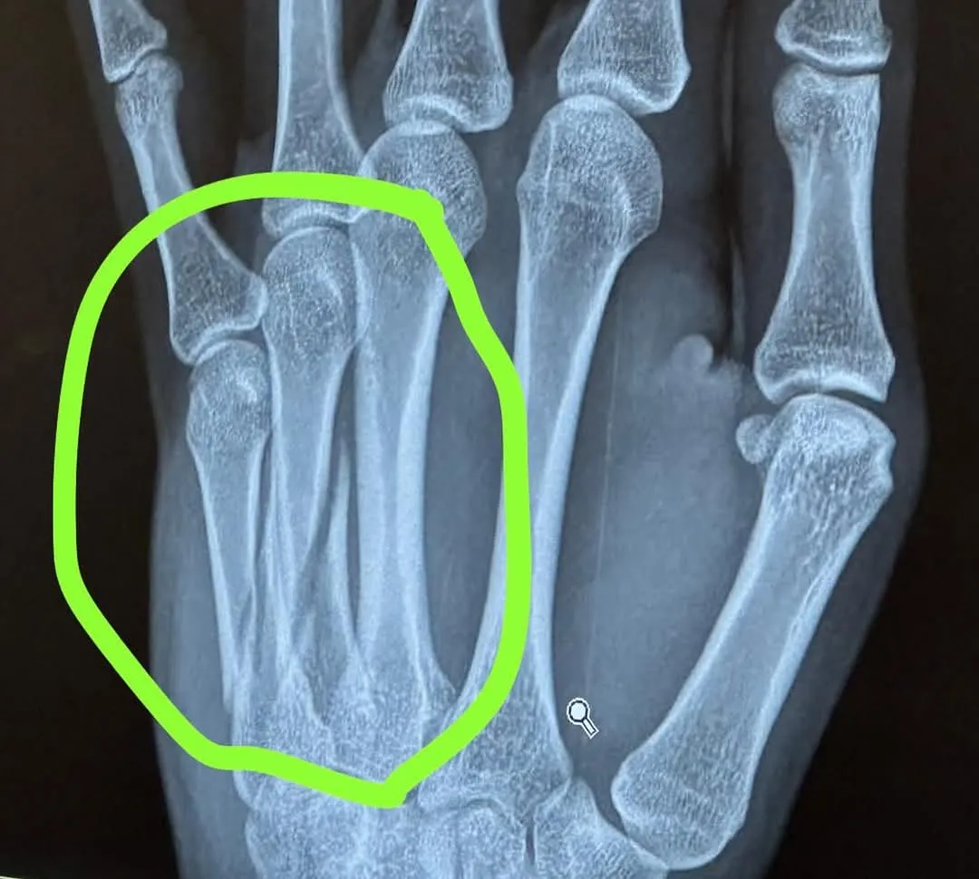 'Een grote tegenslag': Worst loopt breuken in hand op in Zonhoven tijdens 'cruciale fase van cross-seizoen'