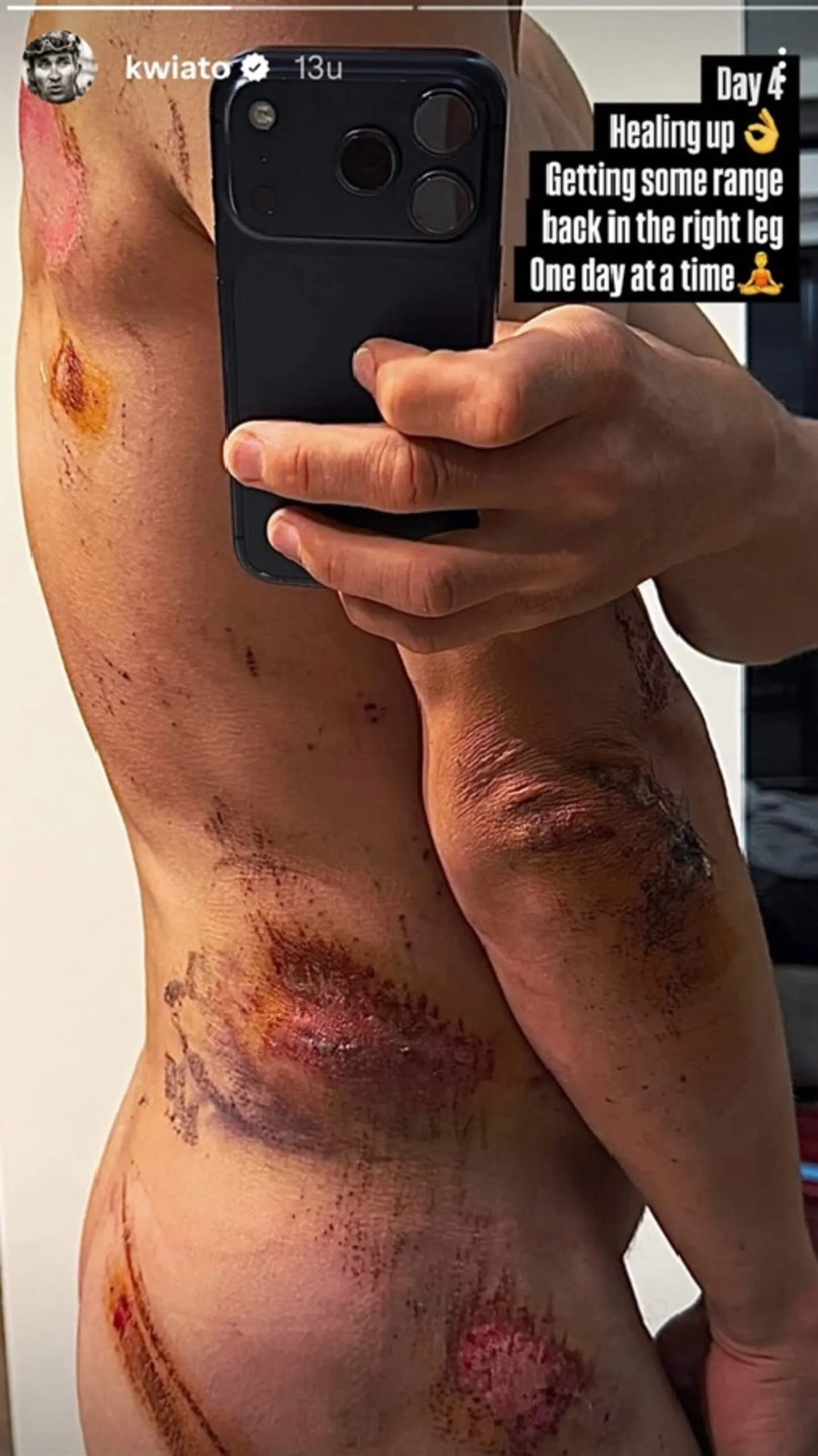 No broken bones, but Kwiatkowski shares grim images of heavy Milan-San Remo crash damage