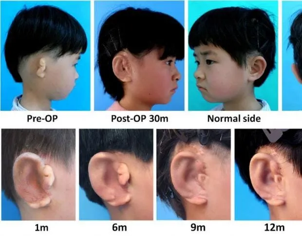 ear grafting