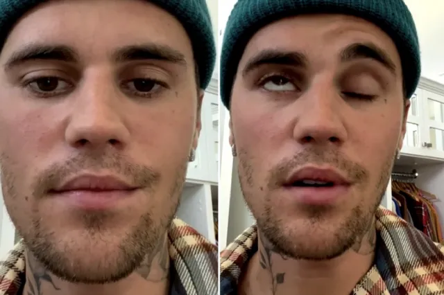 Justin Bieber shockeert fans met verlamd gezicht door zeldzame ziekte (Video)