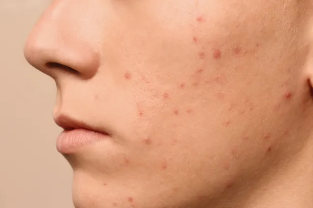 Kun je acné krijgen van stress?