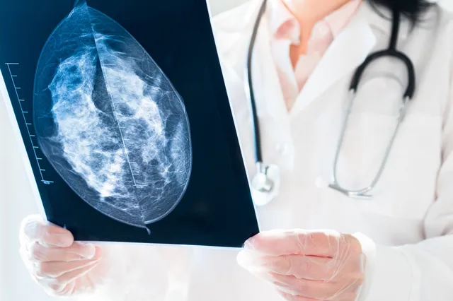 Kunstmatige intelligentie ontdekt borstkanker vaker dan artsen
