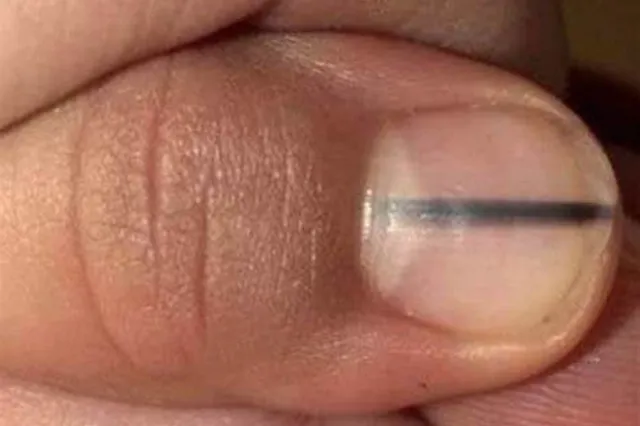 Huidkanker: deze tekenen op je nagels kunnen wijzen op melanoom