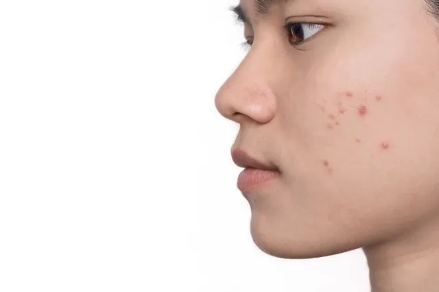 Onderzoekers ontdekken groot voordeel van acne