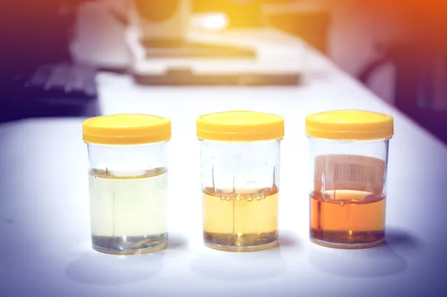 Wat de kleur van je urine zegt over je gezondheid