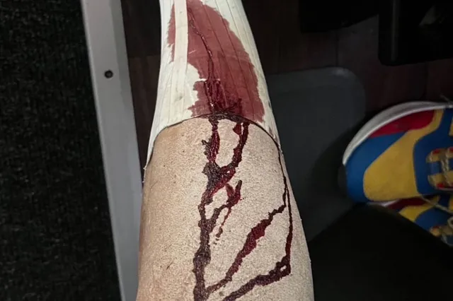 Mathias Vacek deelt schokkende foto na valpartij in Strade Bianche: "Vijf hechtingen in de knie"