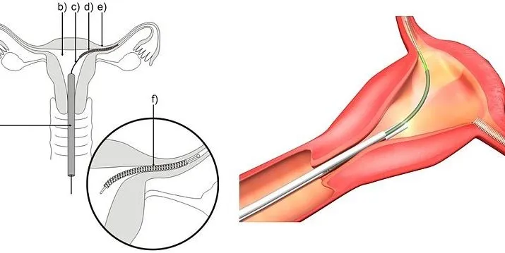 essure methode petr kov mudr havov wikimedia