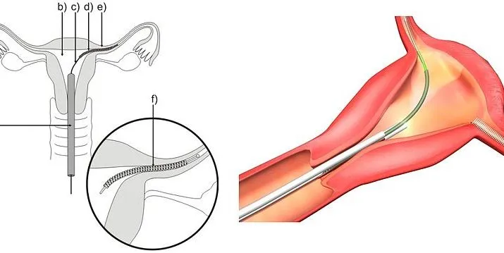 essure petr kov mudr havov wikimedia 715x359