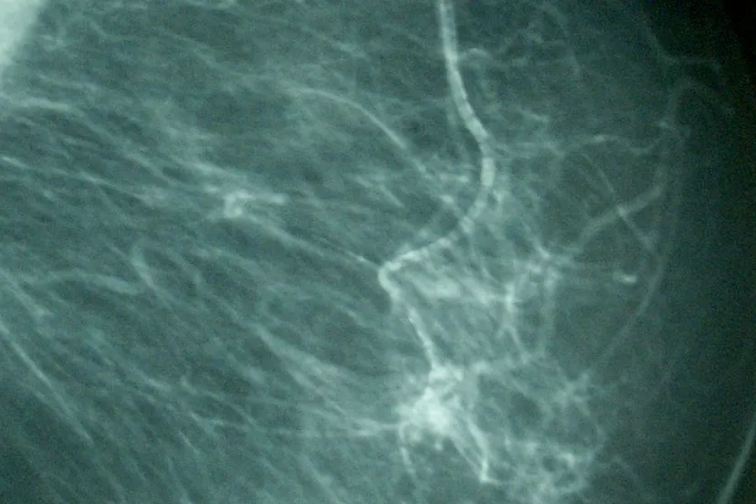 mamografa birads iv e1460999675715