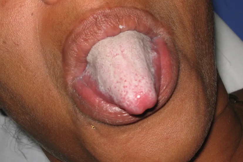 langue saburrale grook da oger cc by sa 30