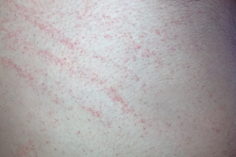 scabies thorax schurft cc bys a 30 fhgd1