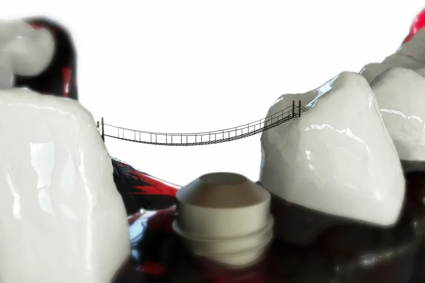 teeth 2833421 1280 implantaat kaak 3d model