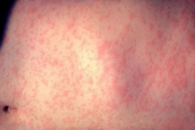 morbillivirus measles infection f5881a