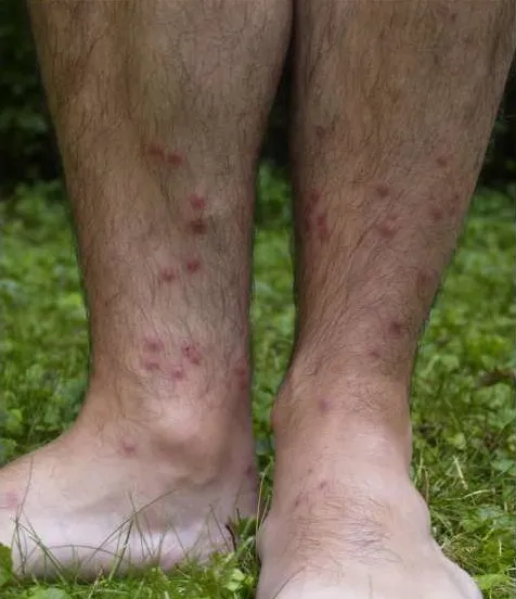 zwemmersjeuk cercarial dermatitis lower legsjpg wikimedia