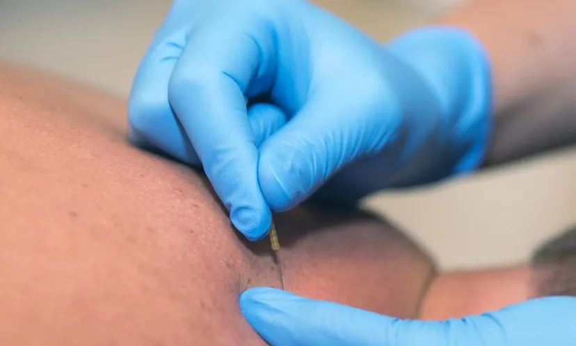 dry needling e1493984847847