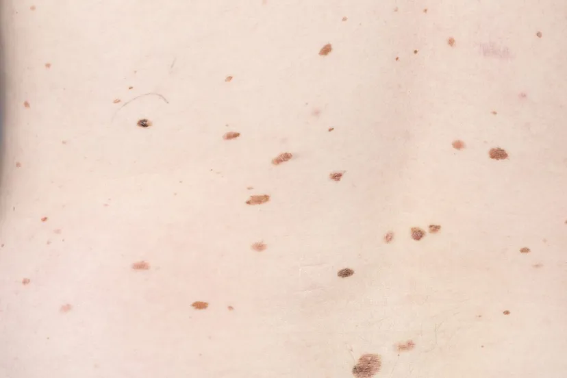 huidkanker moedervlekken e1523527927679