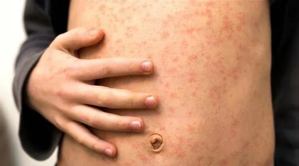 mazelen ggd flevoland