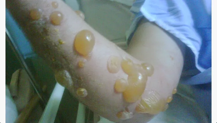 berenklauw brandwond