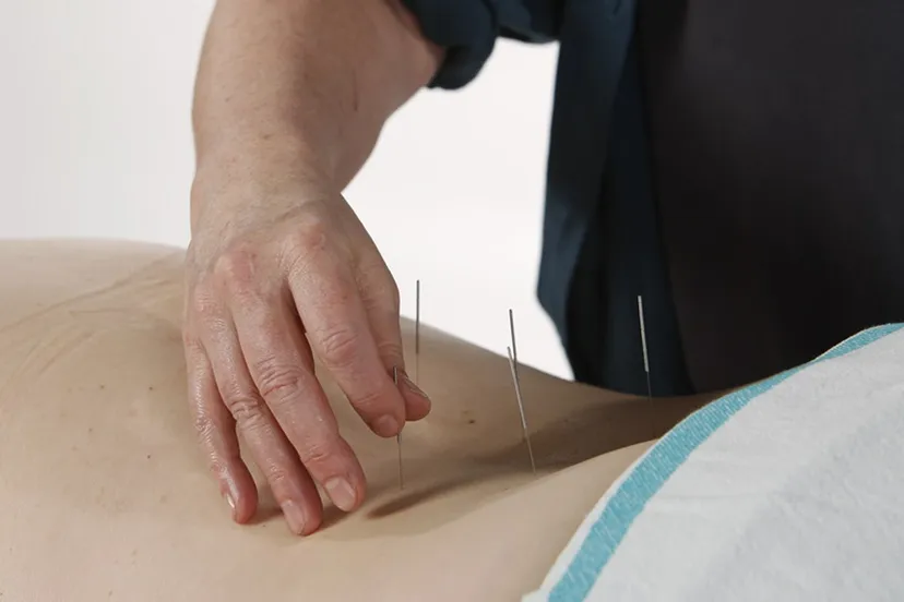 acupunktuur