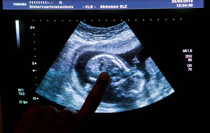vuile lucht risico voor hersenen foetus