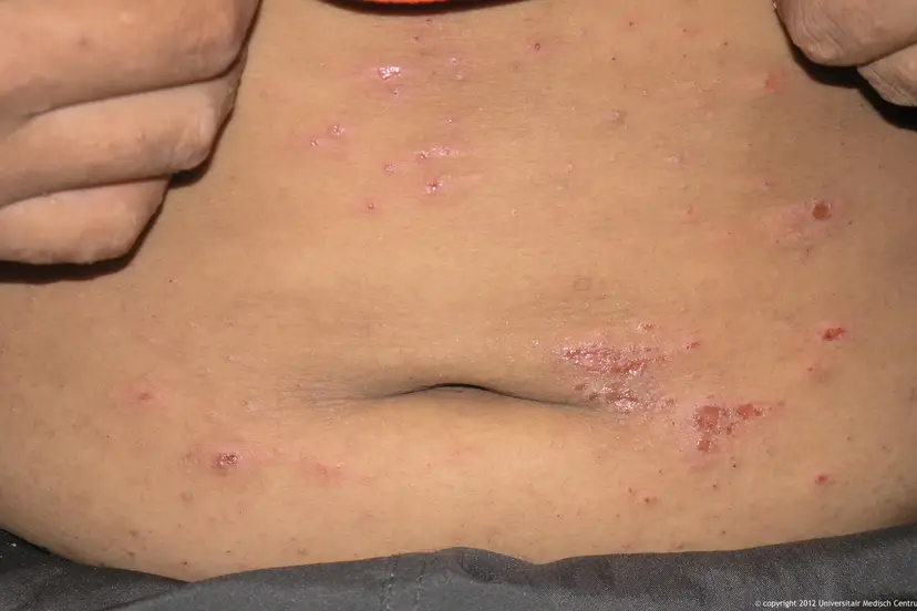 scabies romp m 8 jr