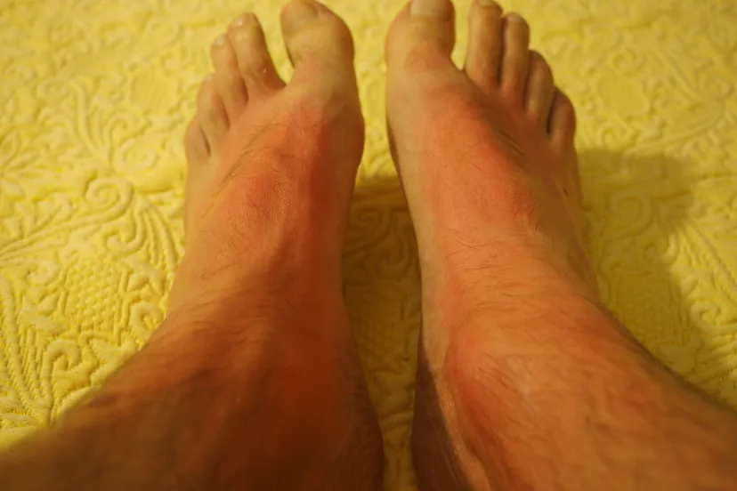 sunburn 1522091 1920