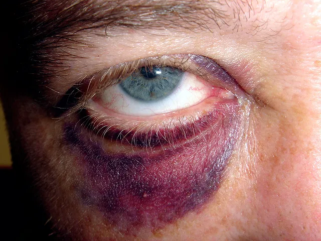 blauw oog dion gillard cc by 20 via flickr