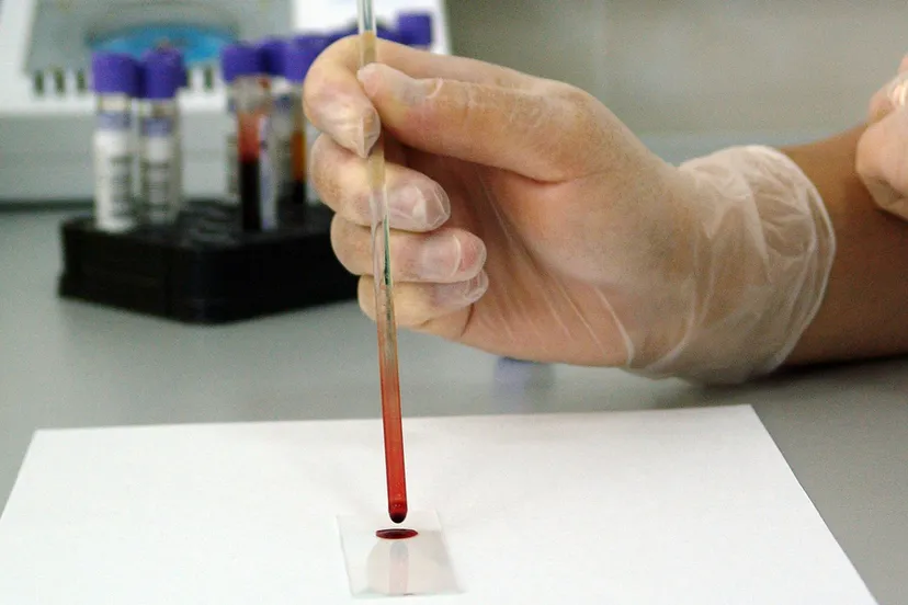 bloedtest cc0 pixabay blood 17305 1280