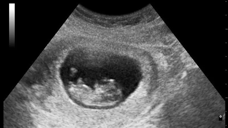 echo 8 weken zwangerschap nevit dilmen