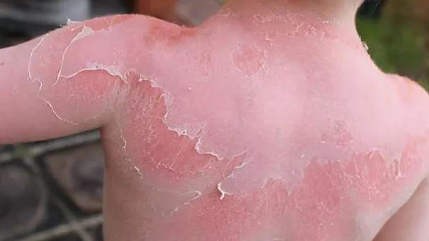 fi1tc49zem8izi53mpi35yp3w verbrand door de zon