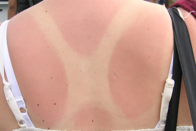 flickr 296893104 818a03cbee o zonnebrand beatrice murch cc by 20