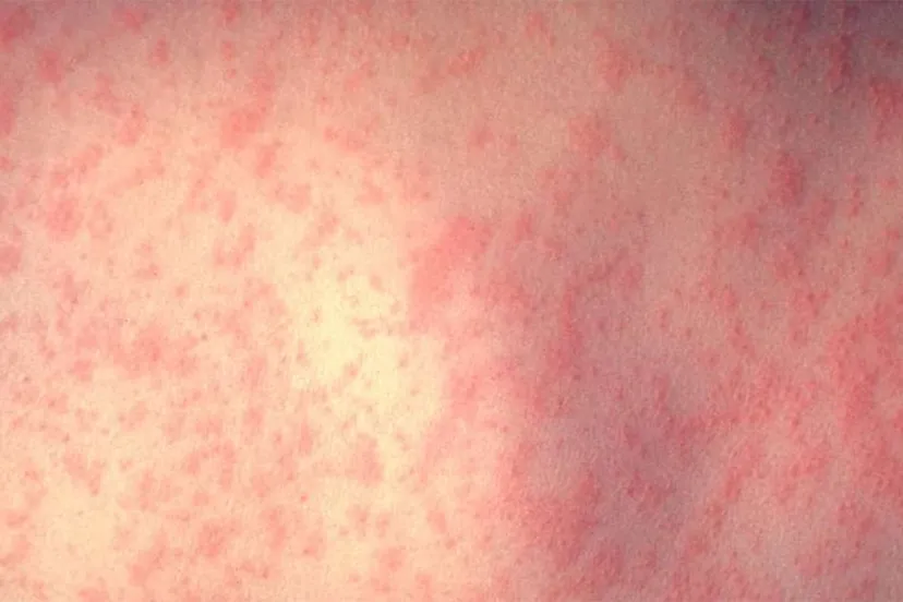 huid persoon met mazelen