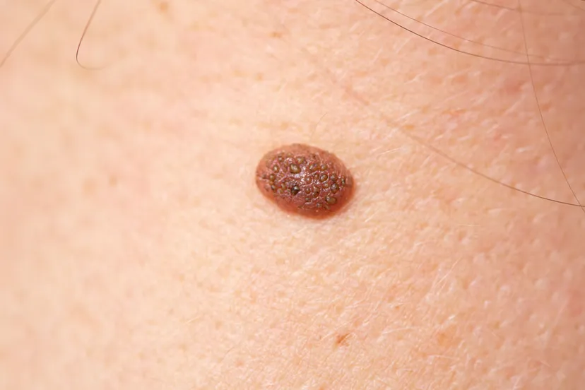 moedervlek of huidkanker