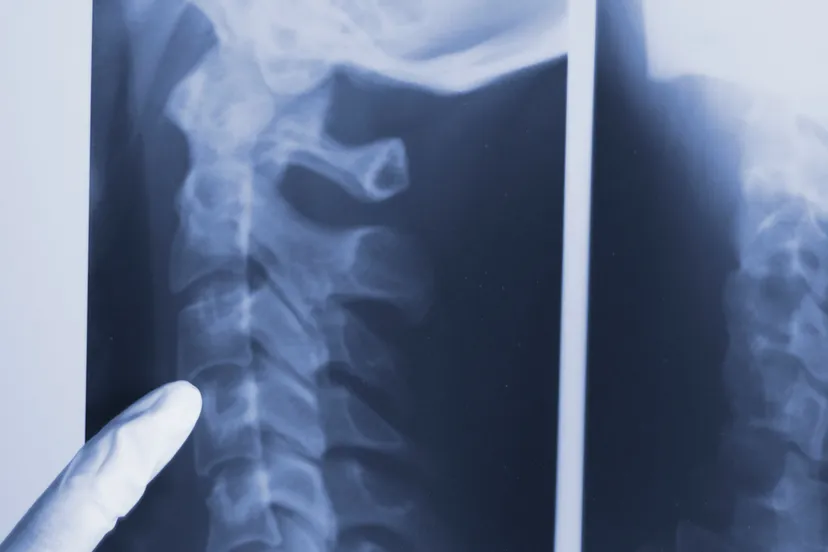 rontgenfotos ruggengraat wervels nek