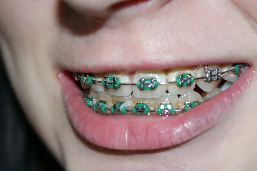 tooth 366335 1280 beugel orthodontie