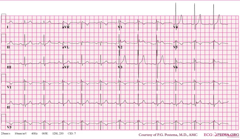 u8i121jo3v6ugynw0ezko0xpd brugada syndroom